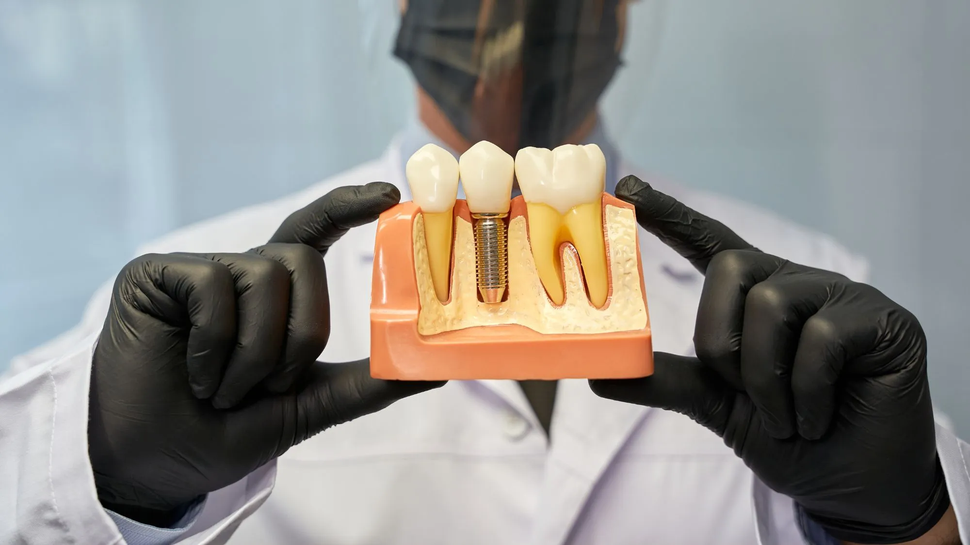 Teeth Implants in Gurgaon