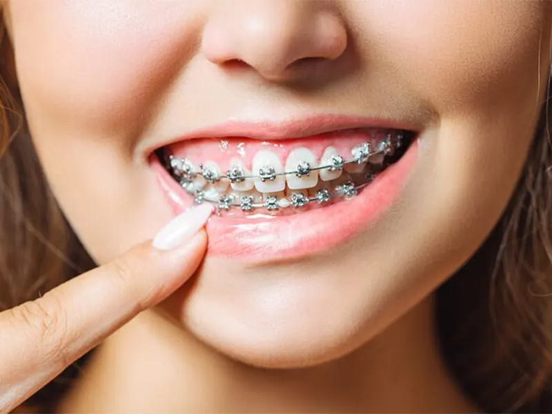 Dental Braces In Gurgaon