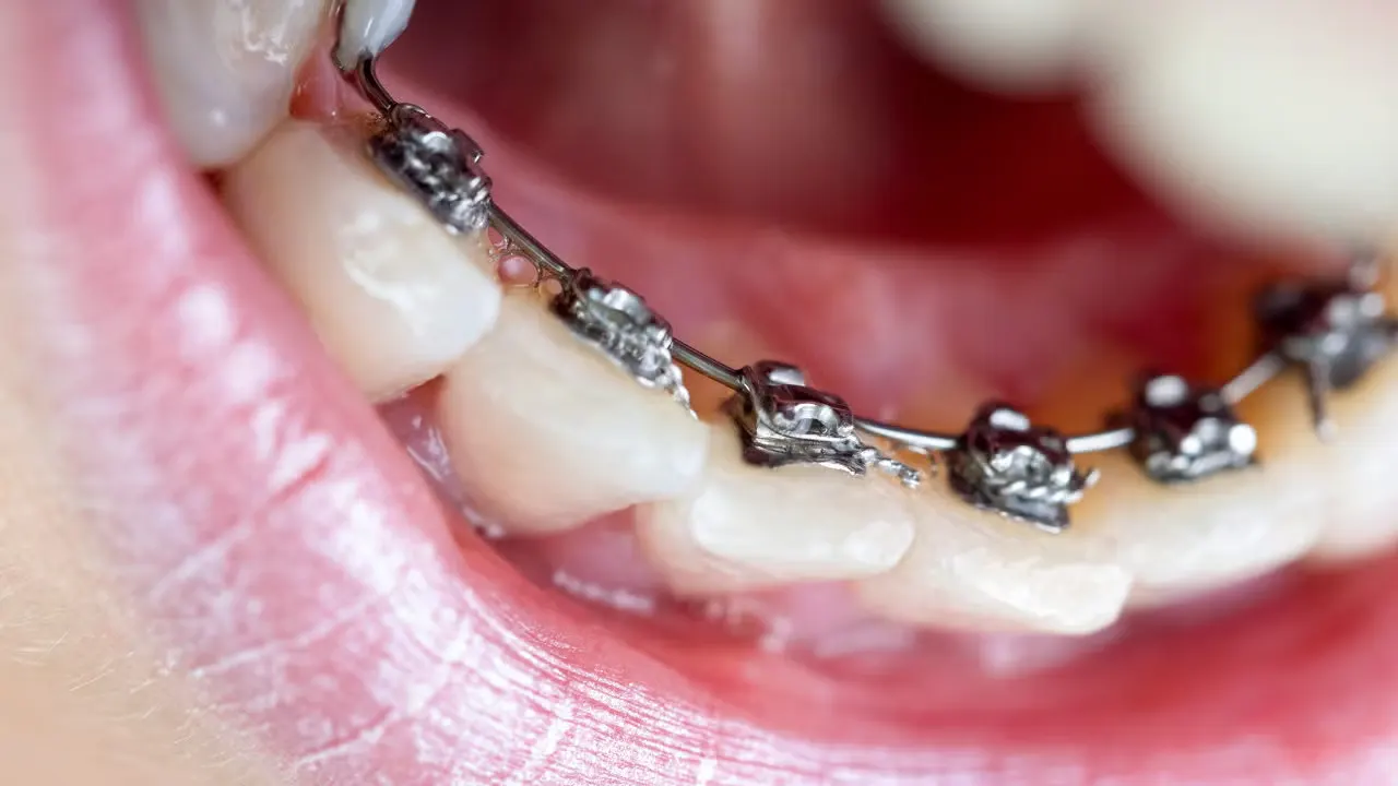 Lingual braces