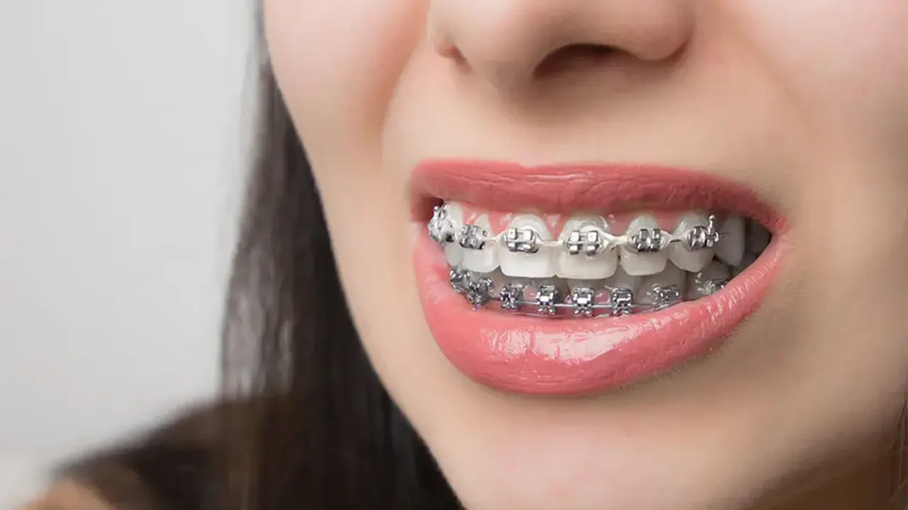 Metal braces