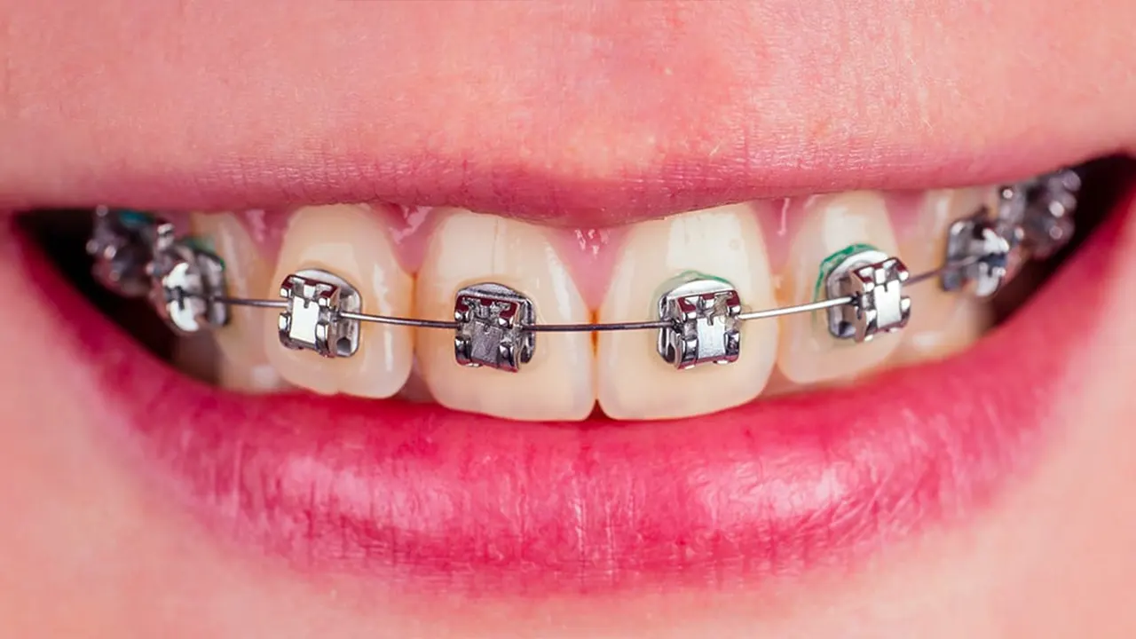 Self-ligating braces