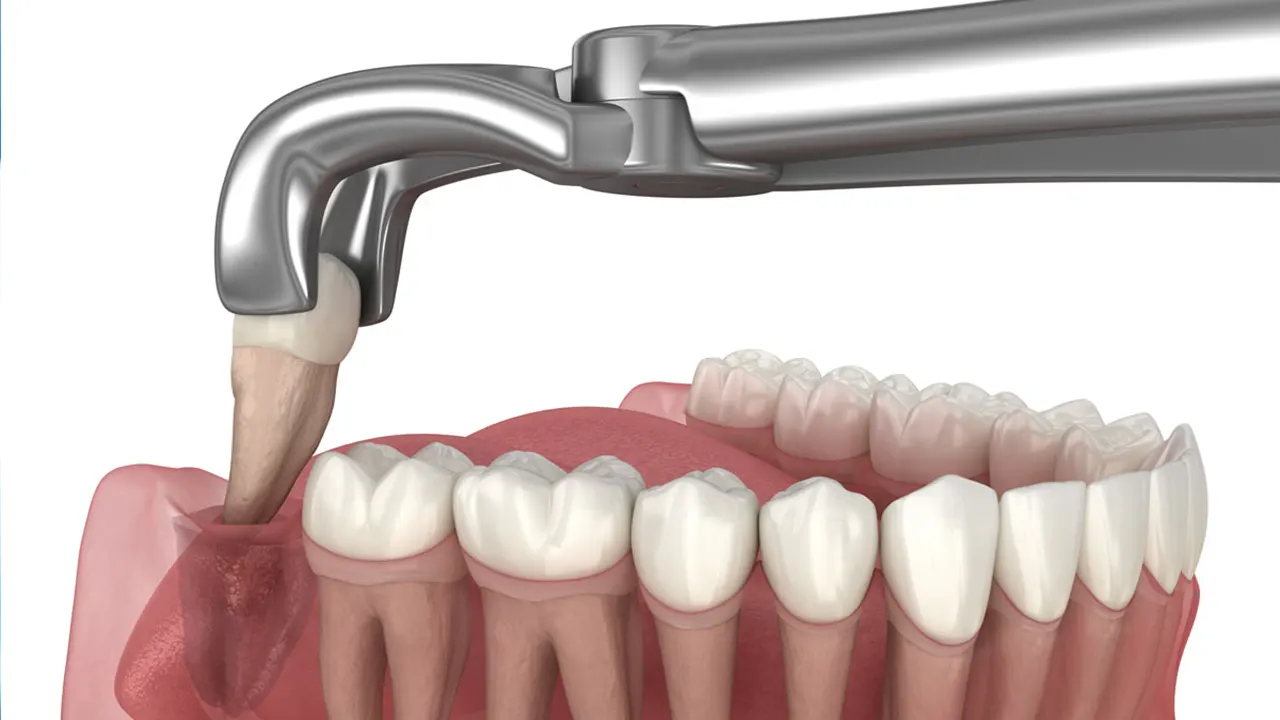 Wisdom Tooth Extraction