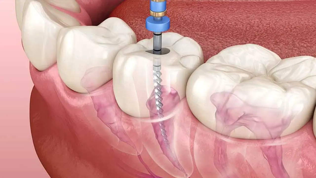 Painless root canal treatment