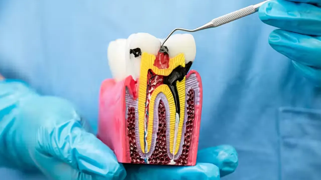 Root Canal Treatment in Gurgaon