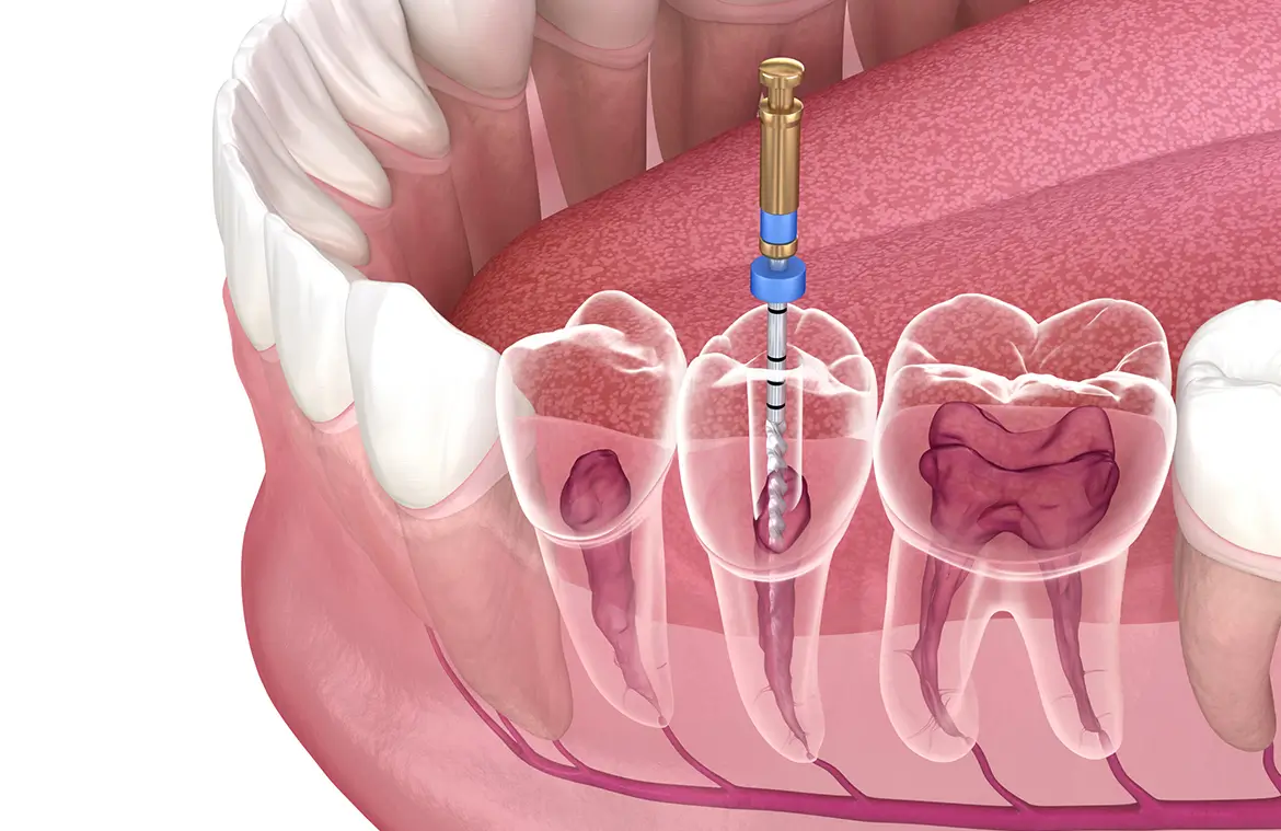 Best Root Canal Treatment in Gurgaon