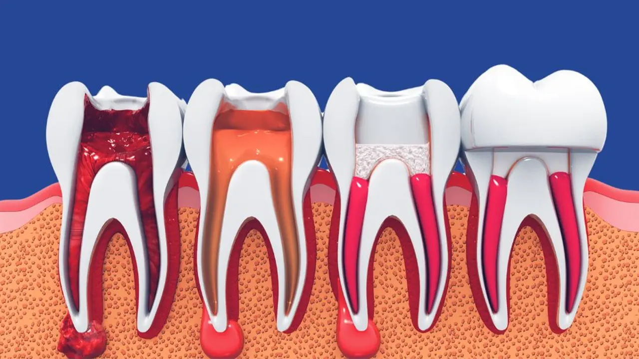 Cost of Root Canal Treatment in Gurgaon