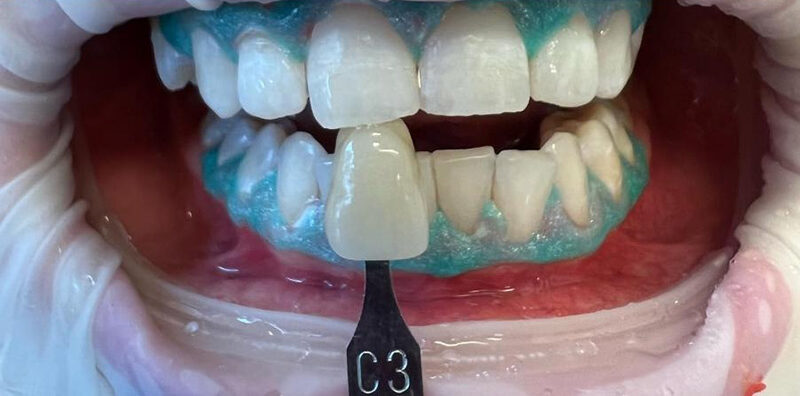 Best Teeth Whitening in Gurgaon