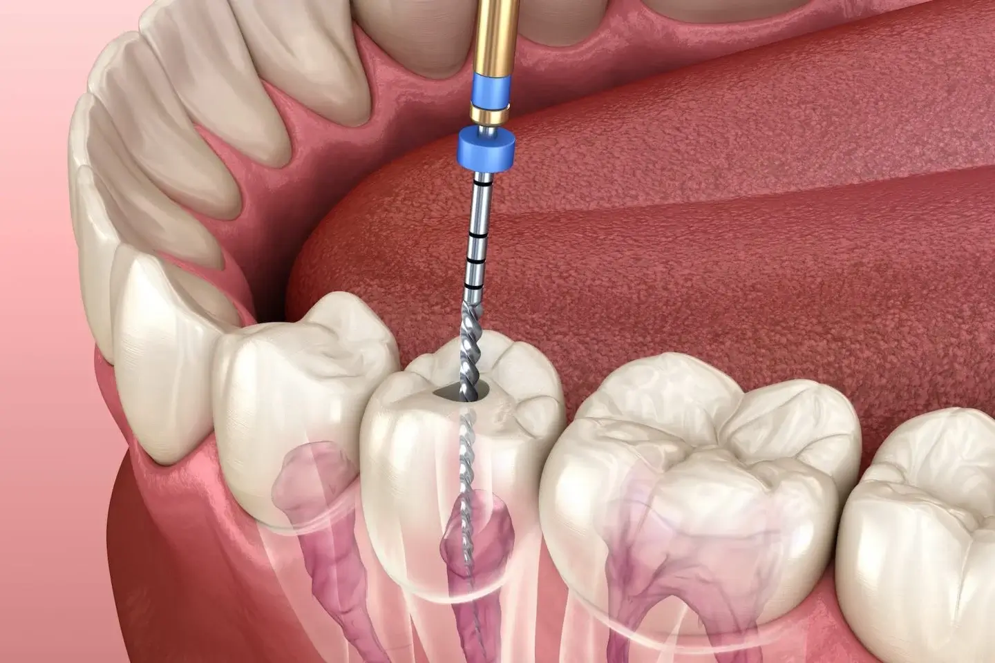 painless root canal treatment in Gurgaon